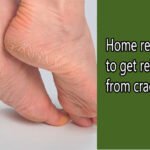 फटी एड़ियों से राहत पाने के घरेलू उपाय, बिना क्रीम के इलाज करें