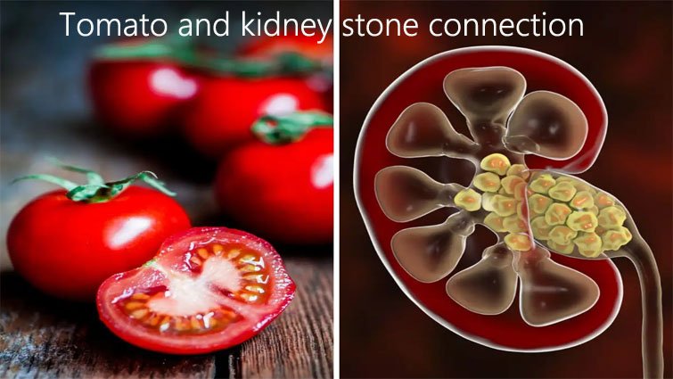कौन सी पथरी में टमाटर खाना नुकसानदायक है?