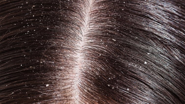 Dandruff: डैंड्रफ से छुटकारा पाने के आसान घरेलू नुस्खे
