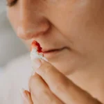 Nosebleeds in Summer