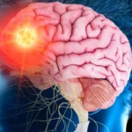Brain Stroke Recovery