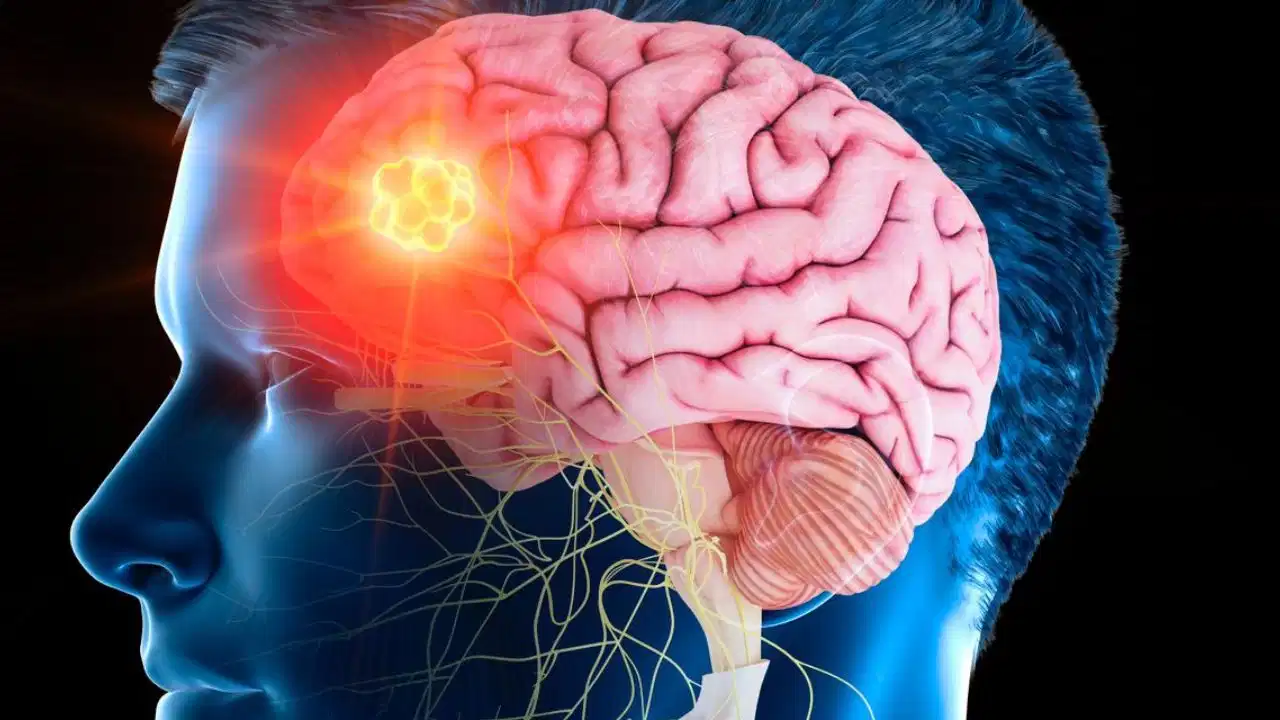 Brain Stroke Recovery
