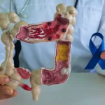 Colon Cancer