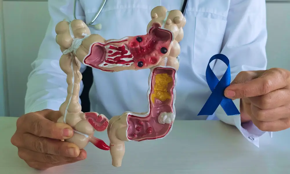 Colon Cancer