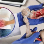 Colon Cancer