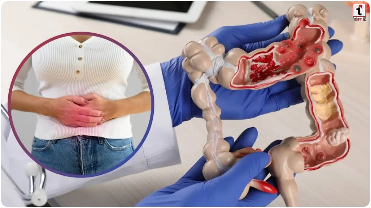 Colon Cancer