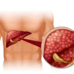 Fatty Liver