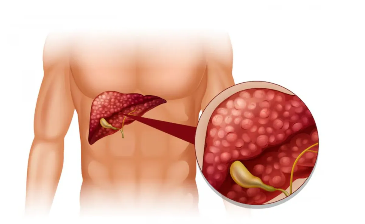 Fatty Liver