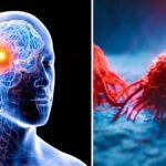Brain Cancer Symptoms