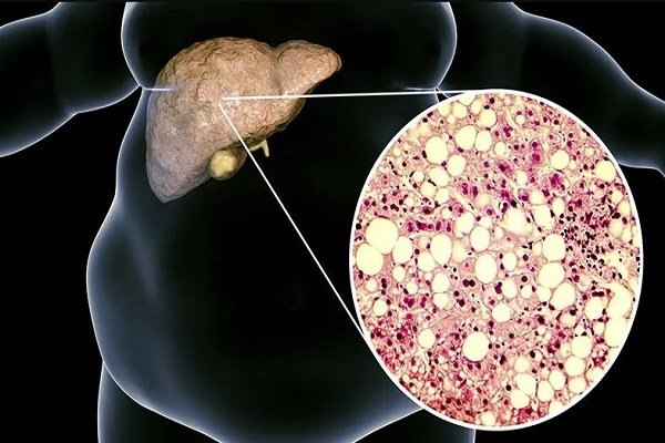 Fatty Liver Alert: AIIMS के अध्ययन ने चौंकाया, 38.6% वयस्क और 35.4% बच्चे प्रभावित
